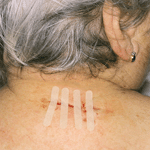 Wound Closure Strips